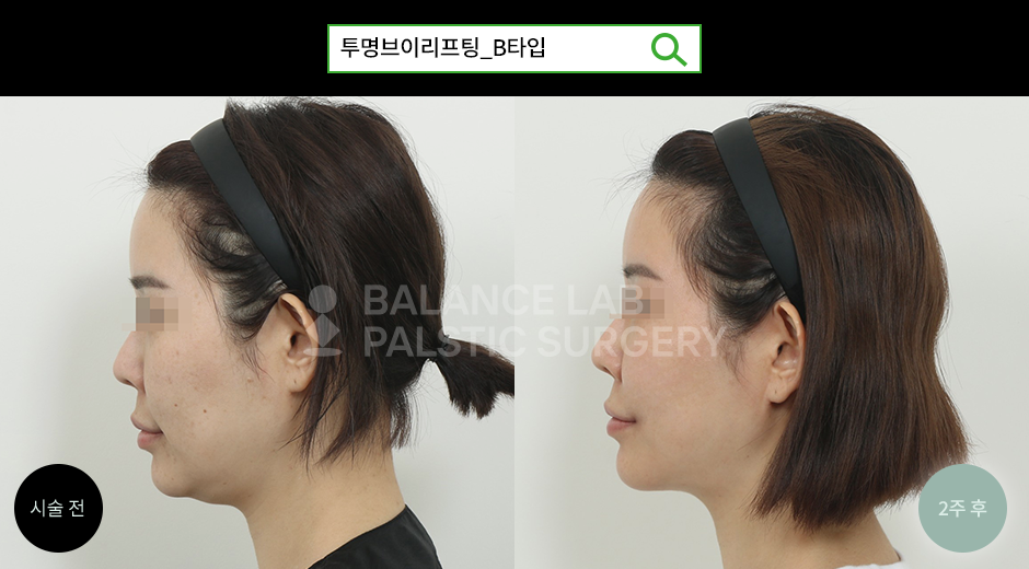 Before 3 Side