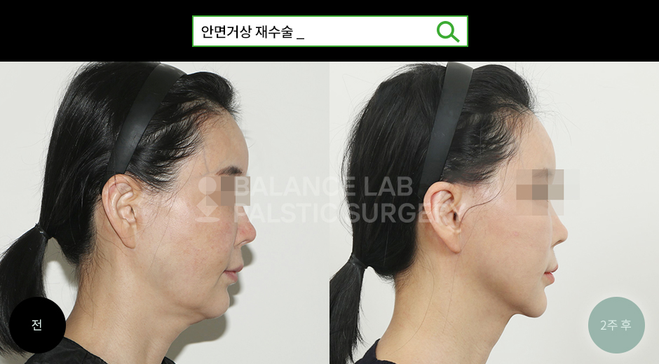 Before 2 Side