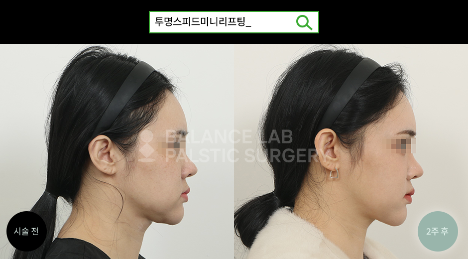 Before 3 Side