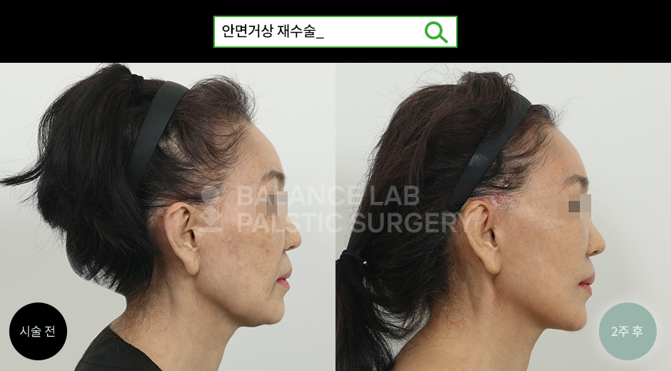 Before 3 Side