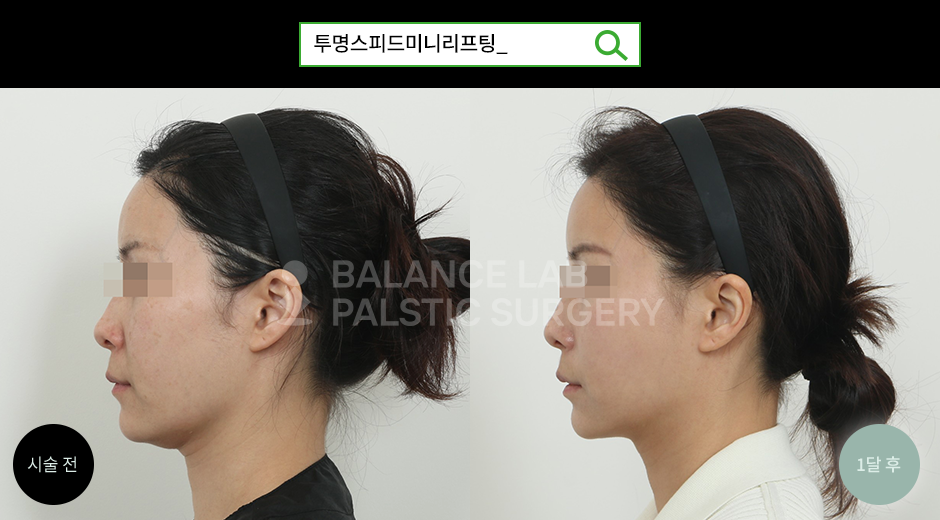 Before 4 Side