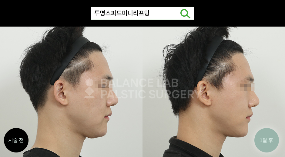 Before 1 Side