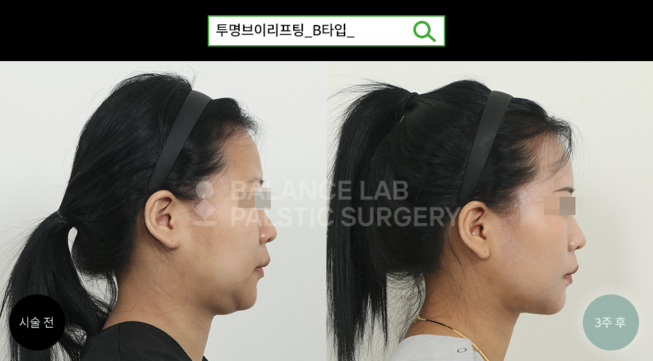 Before 2 Side