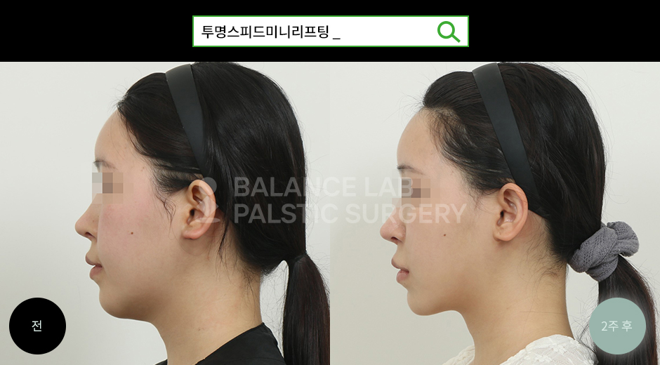 Before 2 Side