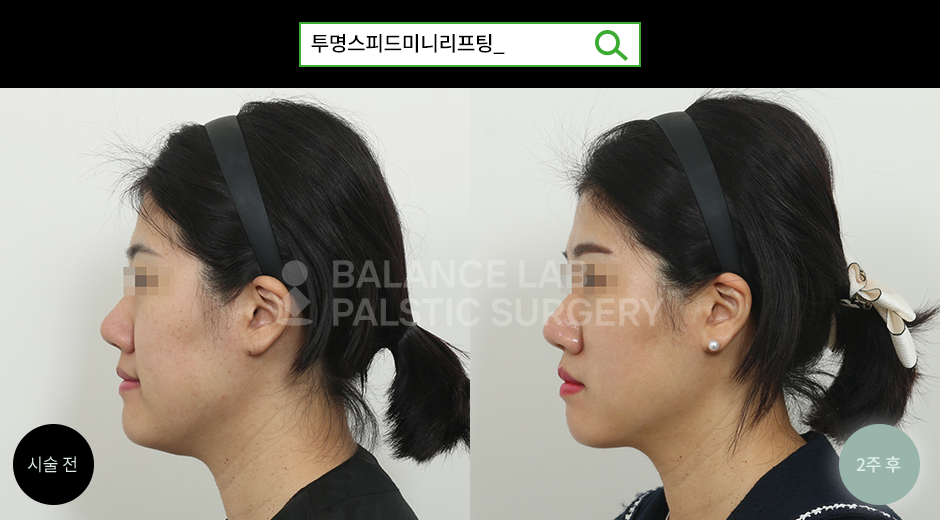 Before 2 Side