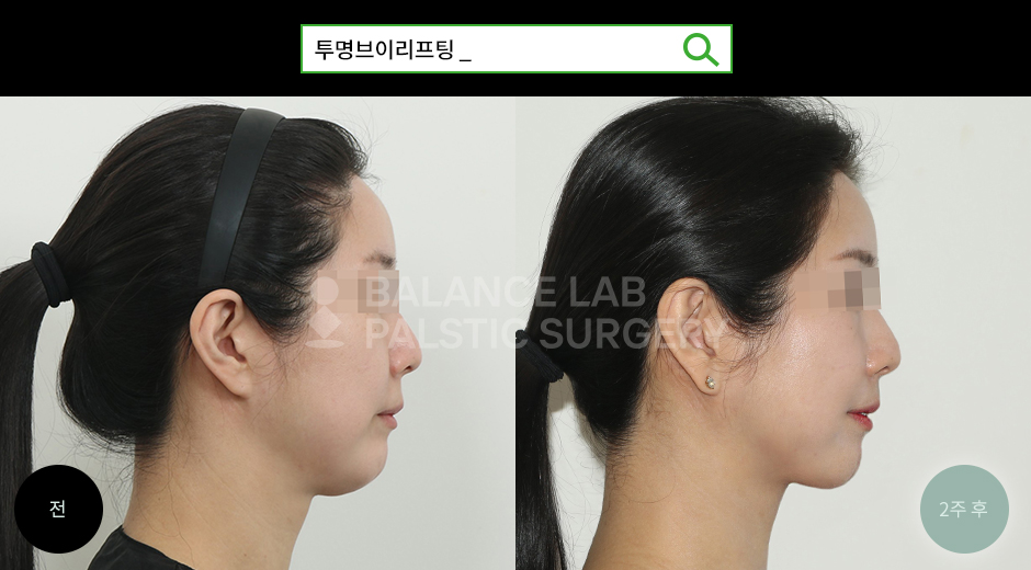 Before 3 Side