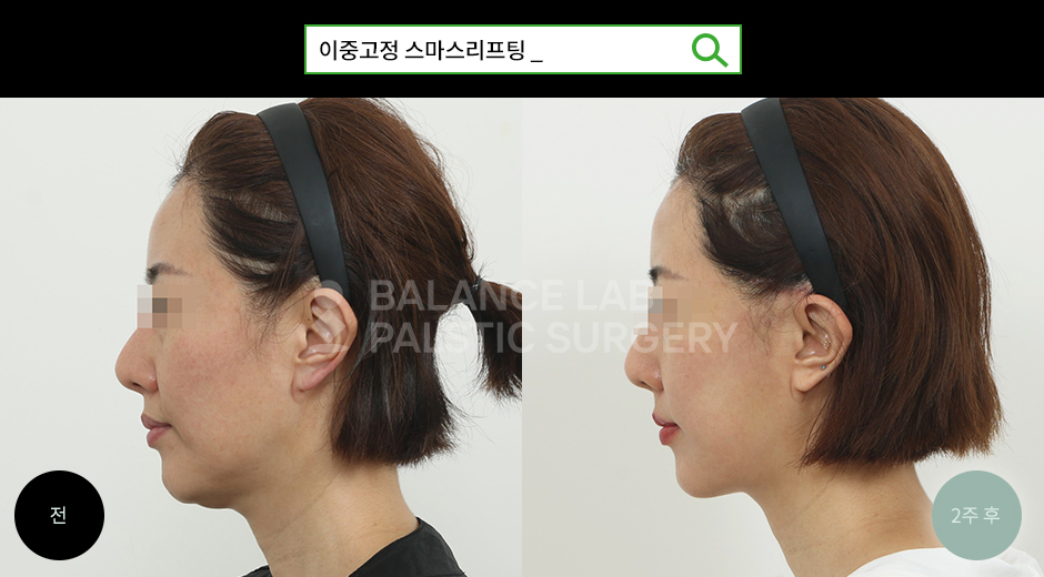 Before 2 Side