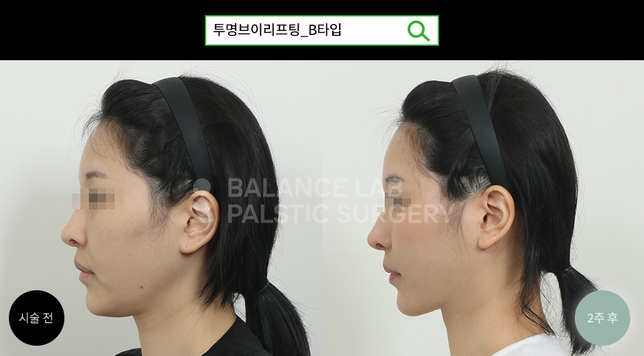 Before 2 Side