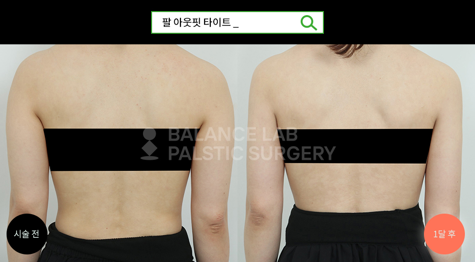Before 2 Side
