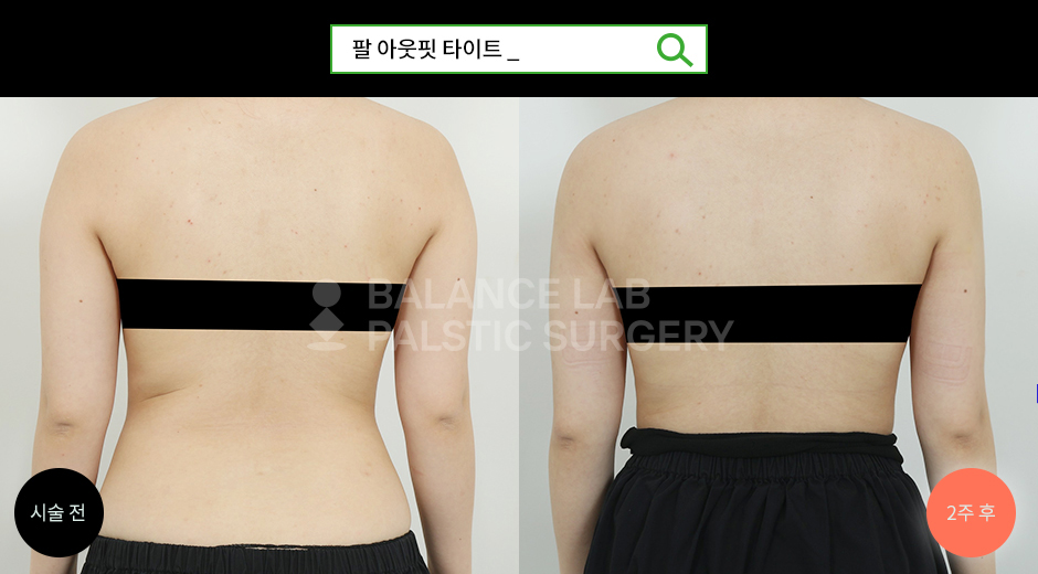 Before 2 Side