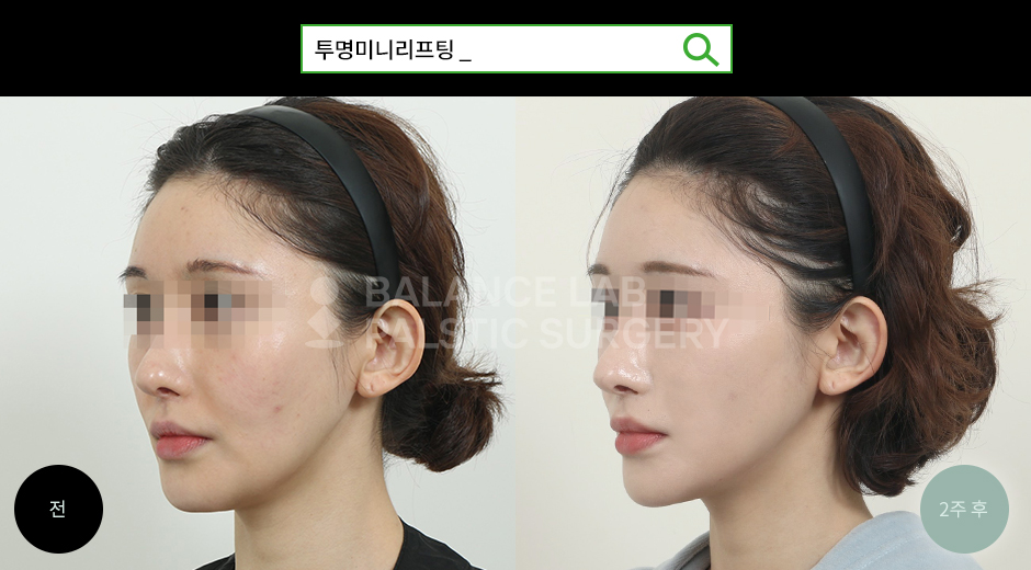 Before 2 Side