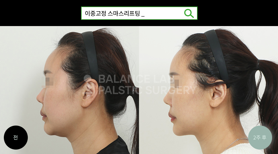 Before 3 Side