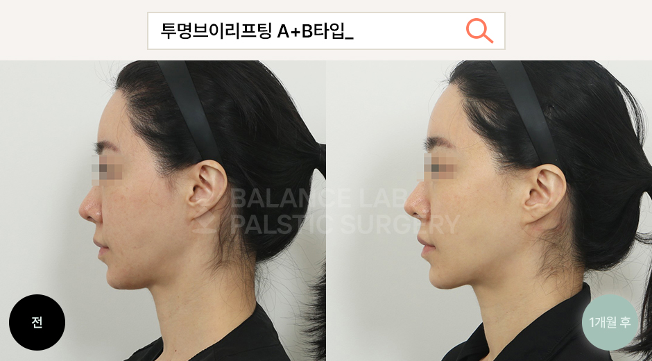 Before 2 Side