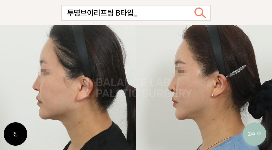 Before 3 Side