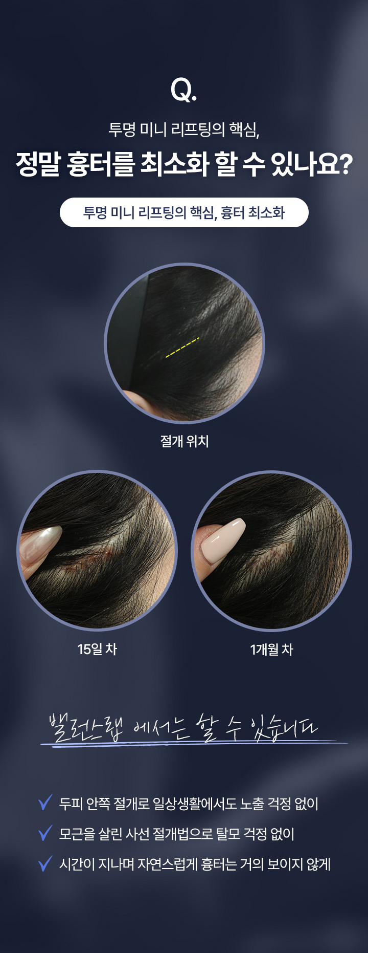 Q. 투명 미니 리프팅의 핵심
정말 흉터를 최소화 할 수 있나요?
[투명 미니 리프팅의 핵심, 흉터 최소화]
밸런스랩 에서는 할 수 있습니다
√두피 안쪽 절개로 일상생활에서도 노출 걱정 없이
√모근을 살린 사선 절개법으로 탈모 걱정 없이
√시간이 지나며 자연스럽게 흉터는 거의 보이지 않게
